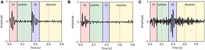 Identification of decompensation episodes in chronic heart failure patients based solely on heart sounds